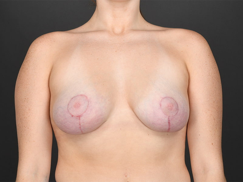 Breast Lift Before & After Image