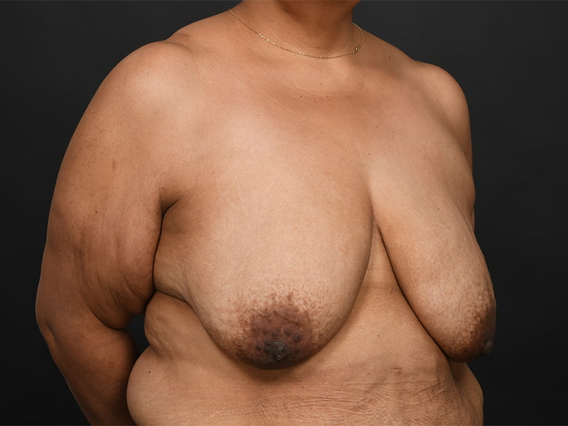 Breast Lift Before & After Image