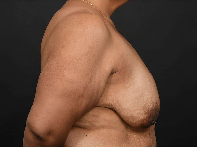 Breast Lift Before & After Image