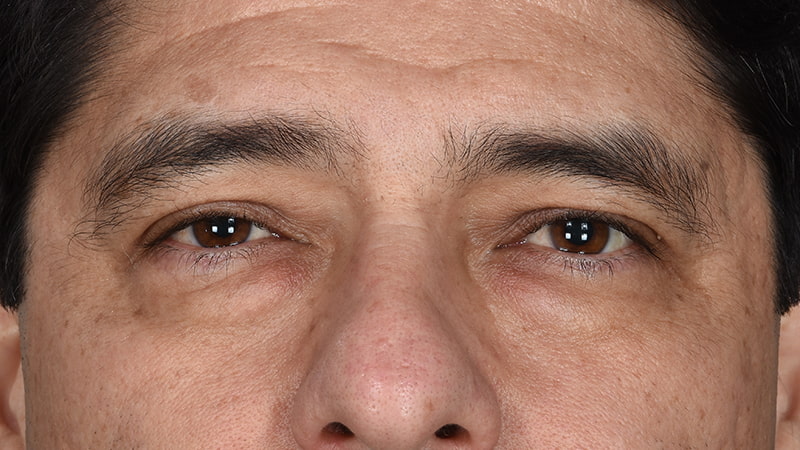 Lower Blepharoplasty Before & After Image