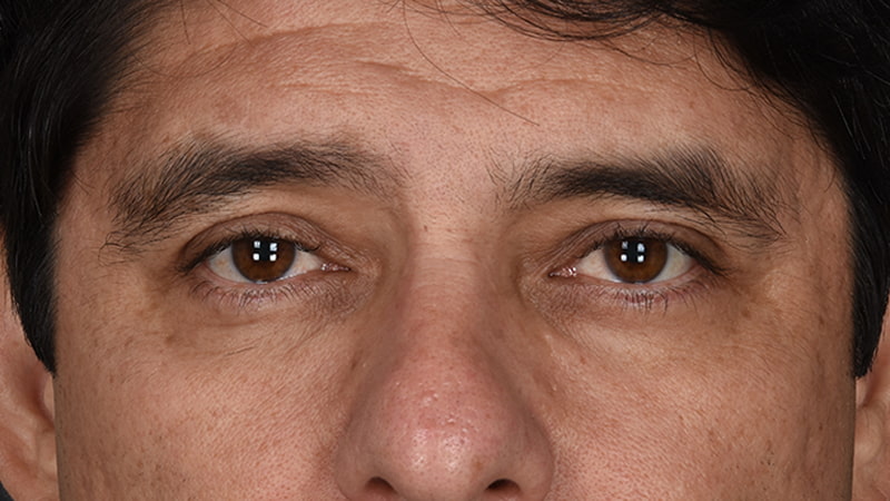 Lower Blepharoplasty Before & After Image