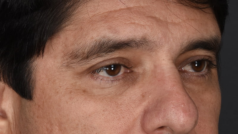 Lower Blepharoplasty Before & After Image