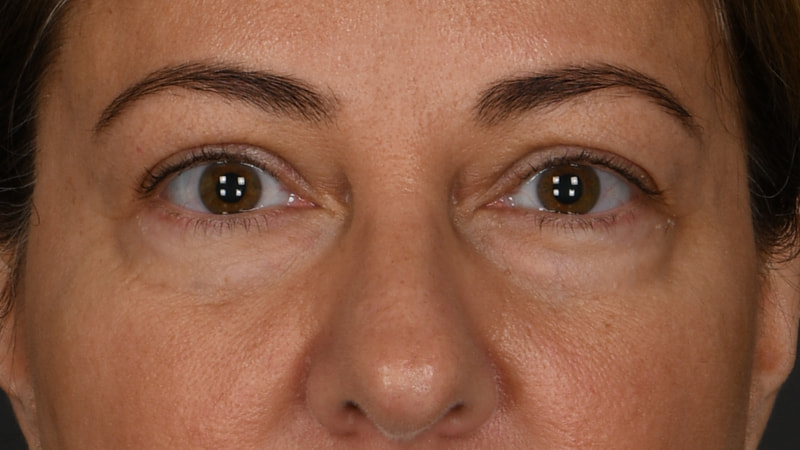 Lower Blepharoplasty Before & After Image