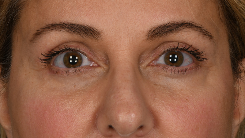 Lower Blepharoplasty Before & After Image