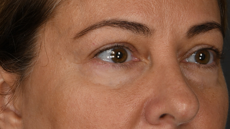 Lower Blepharoplasty Before & After Image