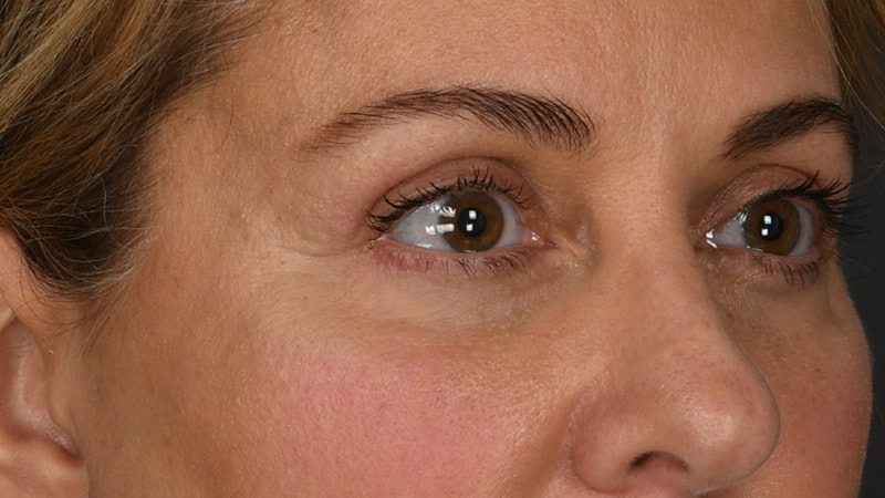 Lower Blepharoplasty Before & After Image