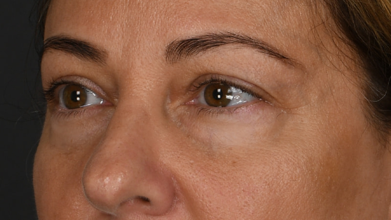 Lower Blepharoplasty Before & After Image