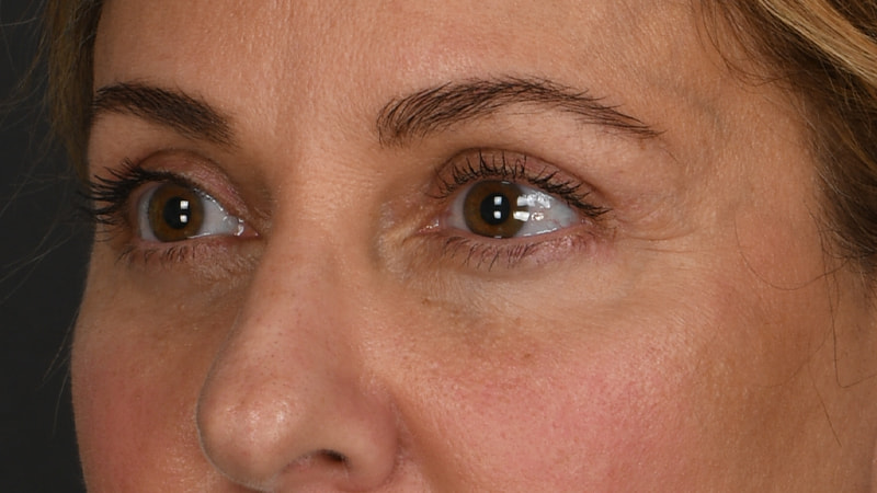 Lower Blepharoplasty Before & After Image