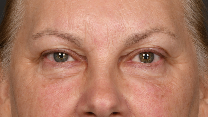 Lower Blepharoplasty Before & After Image