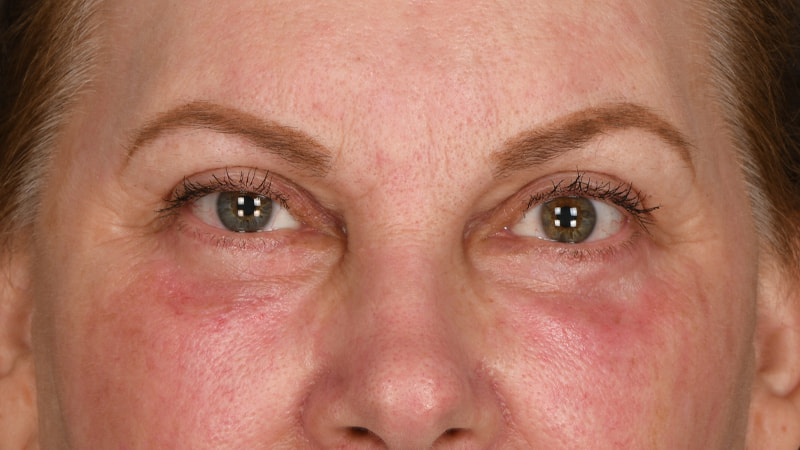 Lower Blepharoplasty Before & After Image