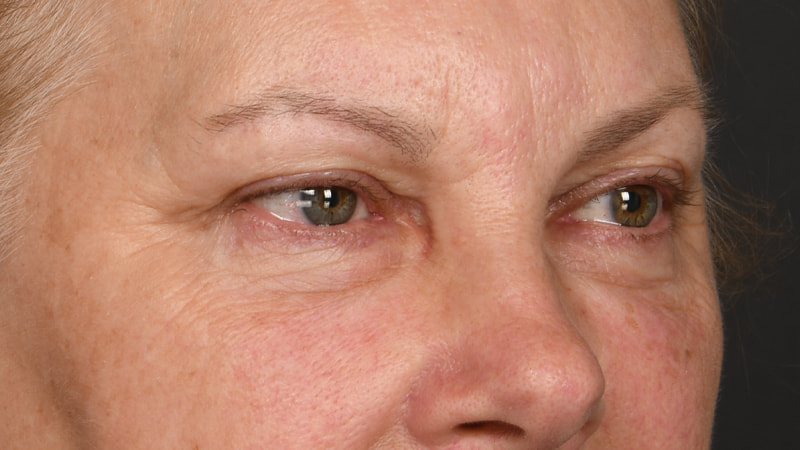 Lower Blepharoplasty Before & After Image