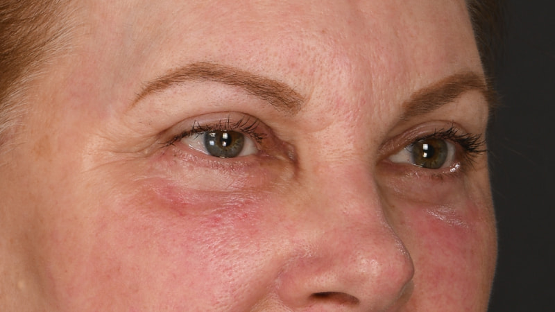 Lower Blepharoplasty Before & After Image