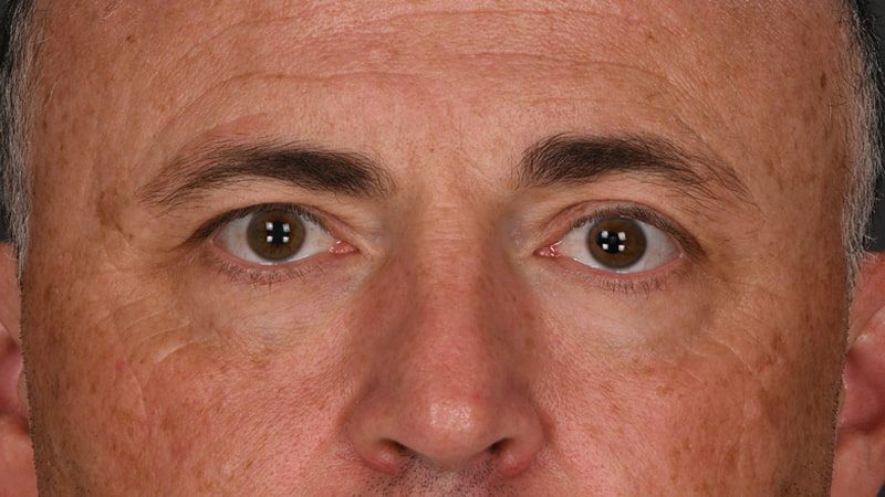 Lower Blepharoplasty Before & After Image