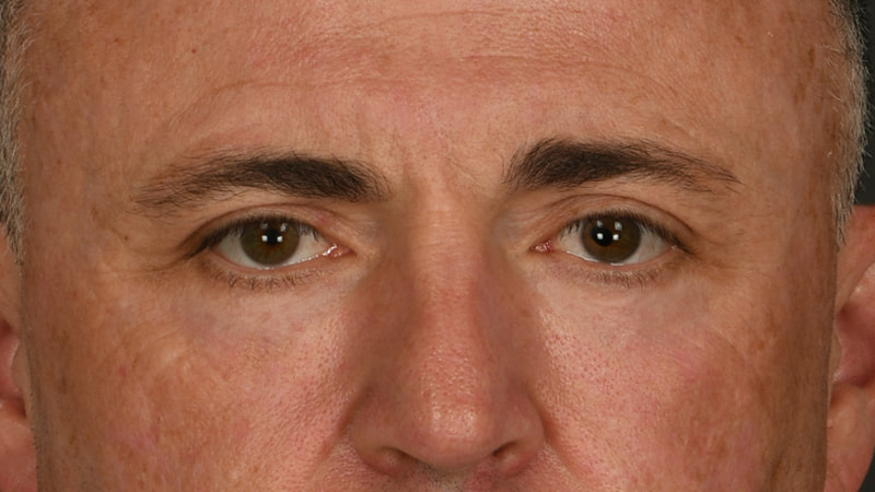 Lower Blepharoplasty Before & After Image