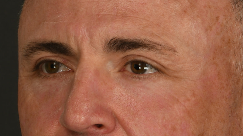 Lower Blepharoplasty Before & After Image