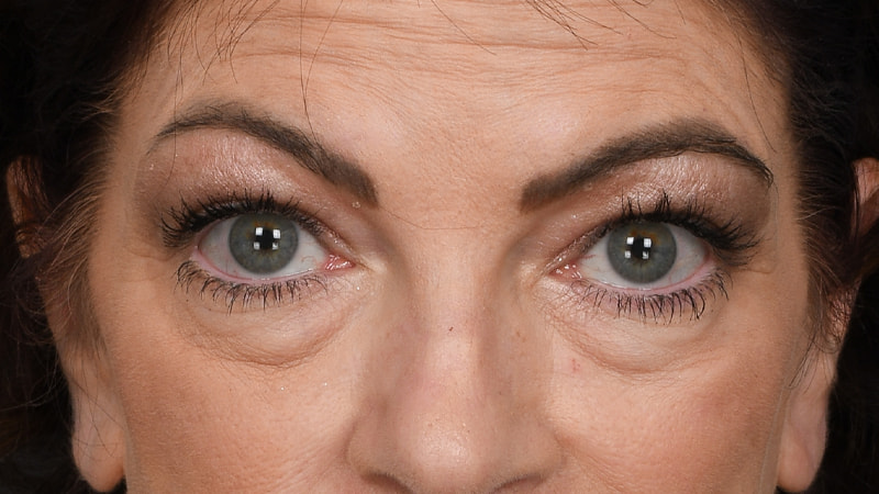 Lower Blepharoplasty Before & After Image