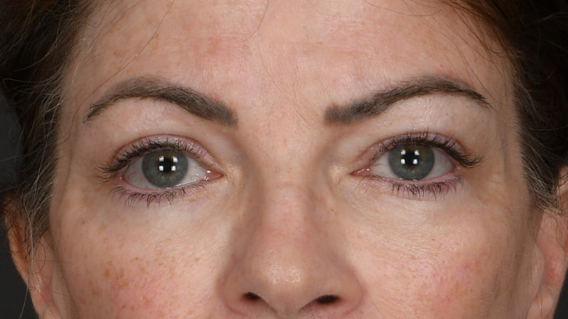 Lower Blepharoplasty Before & After Image