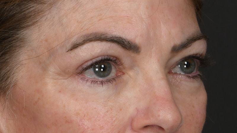 Lower Blepharoplasty Before & After Image