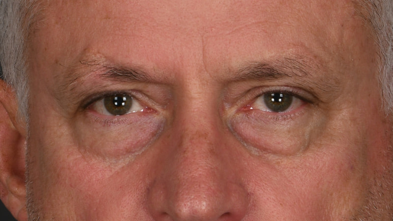 Lower Blepharoplasty Before & After Image