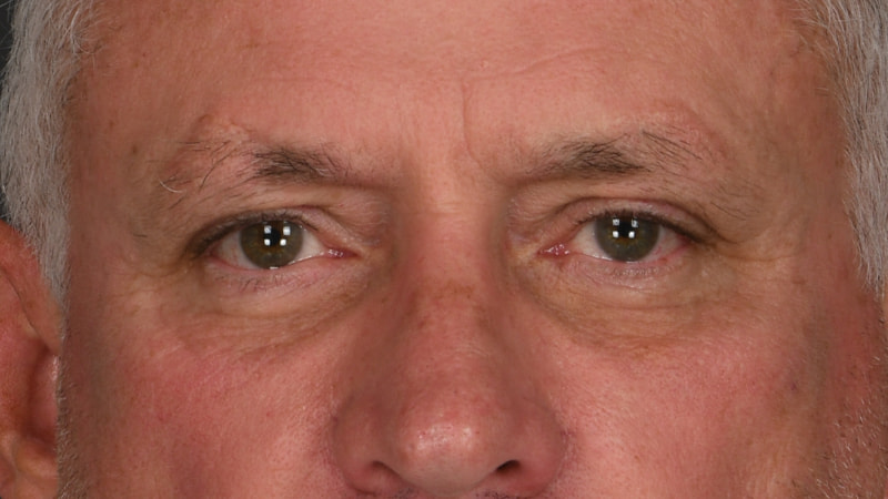 Lower Blepharoplasty Before & After Image