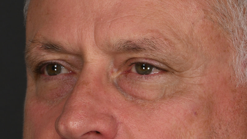 Lower Blepharoplasty Before & After Image