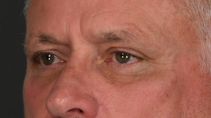 Lower Blepharoplasty Before & After Image